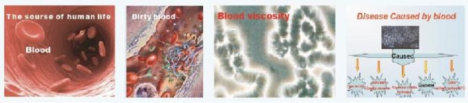 هماچوری لیزر ویسکوزیته قند خون بالا کلسترول سطح پایین درمان لیزر دیده بان