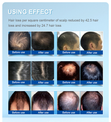 کارخانه جدیدترین مدل محبوب رشد مجدد مو در مردان و زنان با فناوری 650 نانومتری Lllt لیزر رشد مجدد موی سر